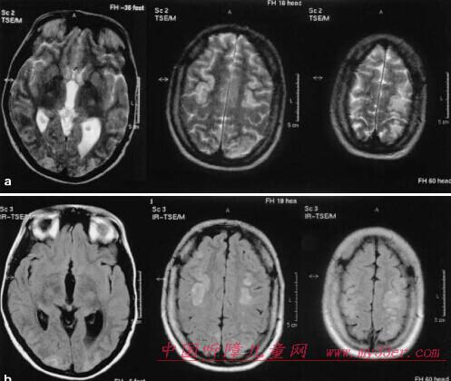 脑白质问题与听力解决策略